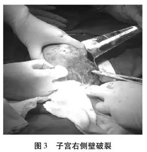 高危妊娠宫外孕切除输卵管,输卵管妊娠破裂手术记录单模板