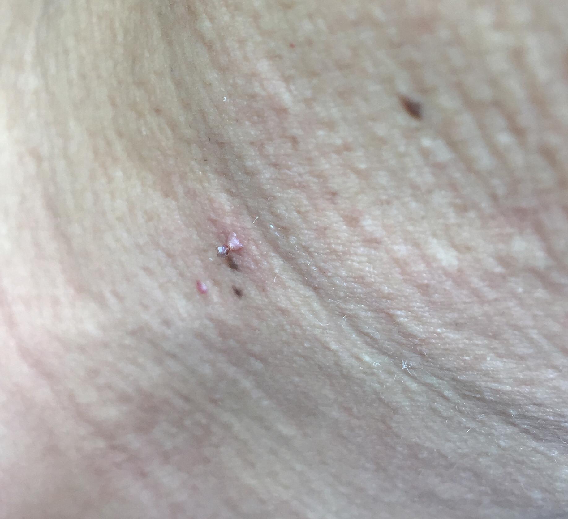 脖子上长瘊子可以用头发拴住吗,大腿上瘊子有什么说法