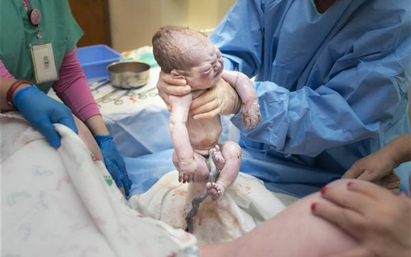 新生儿无尿护理措施,新生儿肚脐护理必备