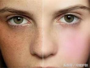 痘痘肌肤坑坑洼洼怎么改善,痘痘暗黄改善方法