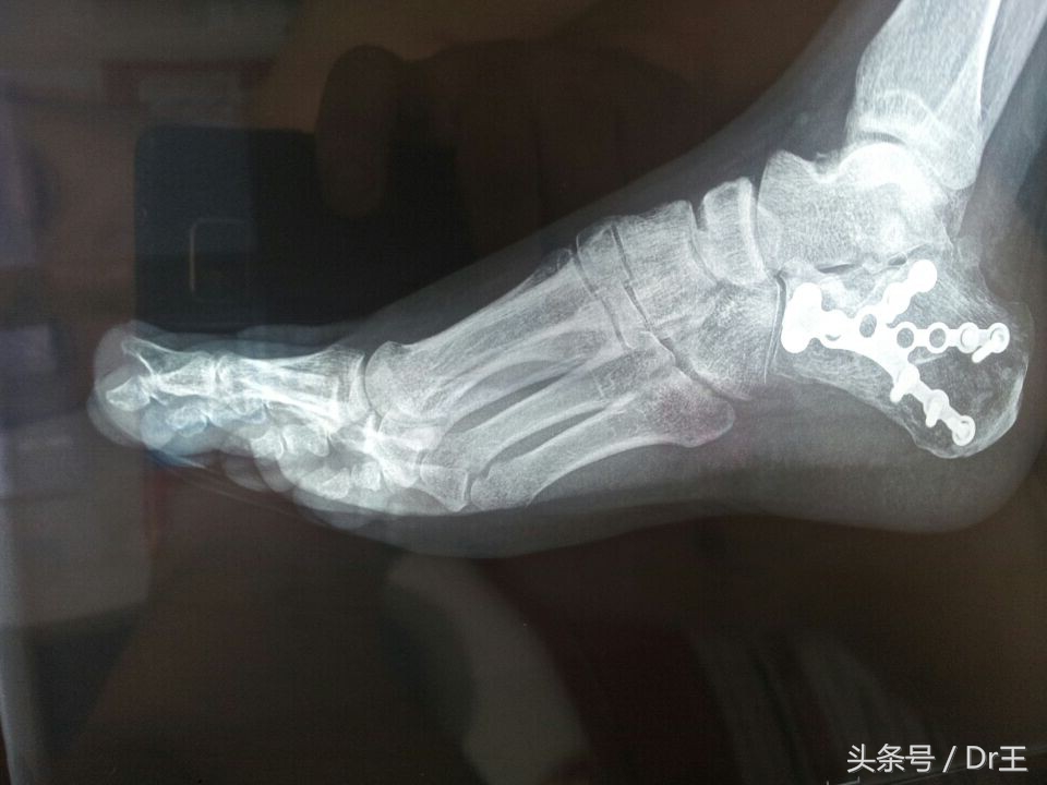 足部疼痛您都了解吗,足部反射区疼痛原因