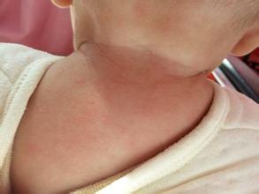 9个月宝宝出疹子注意些什么,宝宝感冒出疹子需要注意什么