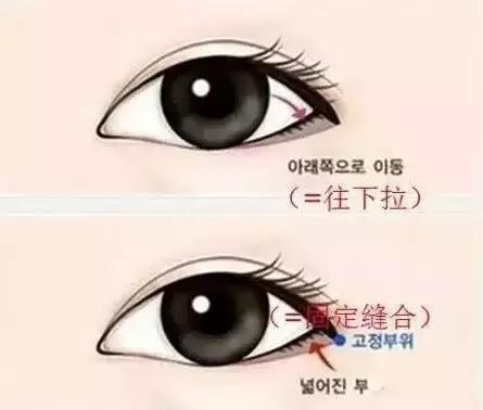 开内眼角和外眼角哪个好看,外眼角上扬适合开外眼角吗