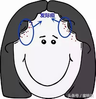 12岁脸上长痘按什么穴位,各个部位长痘原因太阳穴