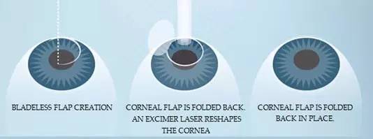 「黑科技」Ocumetics能让你永久告别近视？