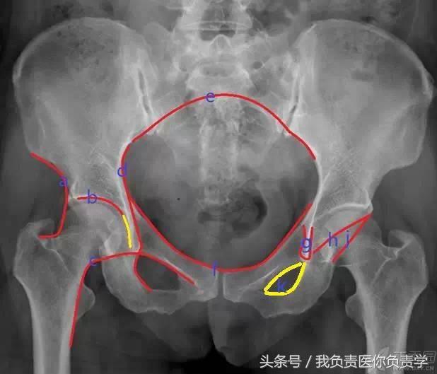 正常骨盆x线片详解,骨科医生只看报告单