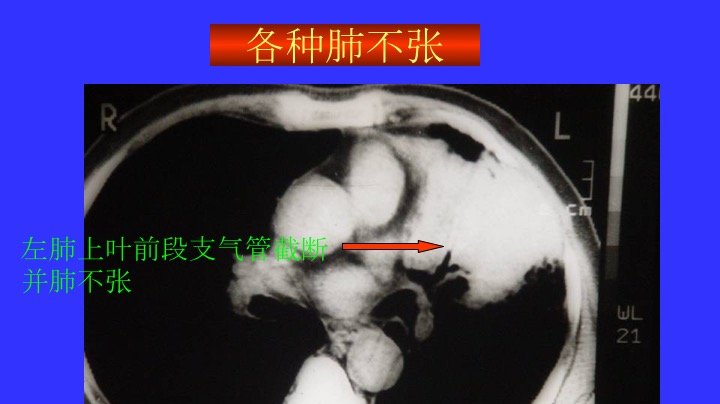 胸部ct扫描双肺未见明显异常,胸部ct报告心脏不大正常吗