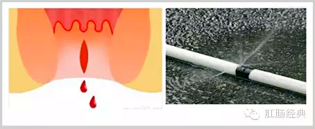 有趣痔疮的知识讲解,怪异的痔疮