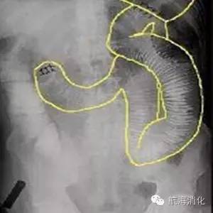 鑳冨垏闄ゆ伅鑲夊悗12灏忔椂楗,鑳冭偁鎭倝鍒囬櫎鍚庝竴鍛ㄥ悗楗