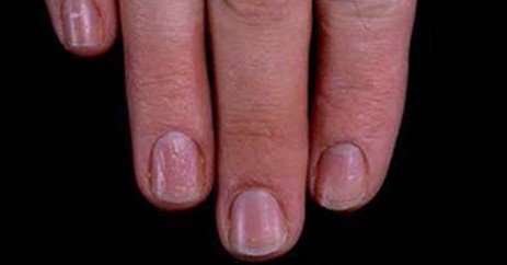观手知健康指甲有白点怎么回事,当指甲发绿发脓的时候要怎么处理