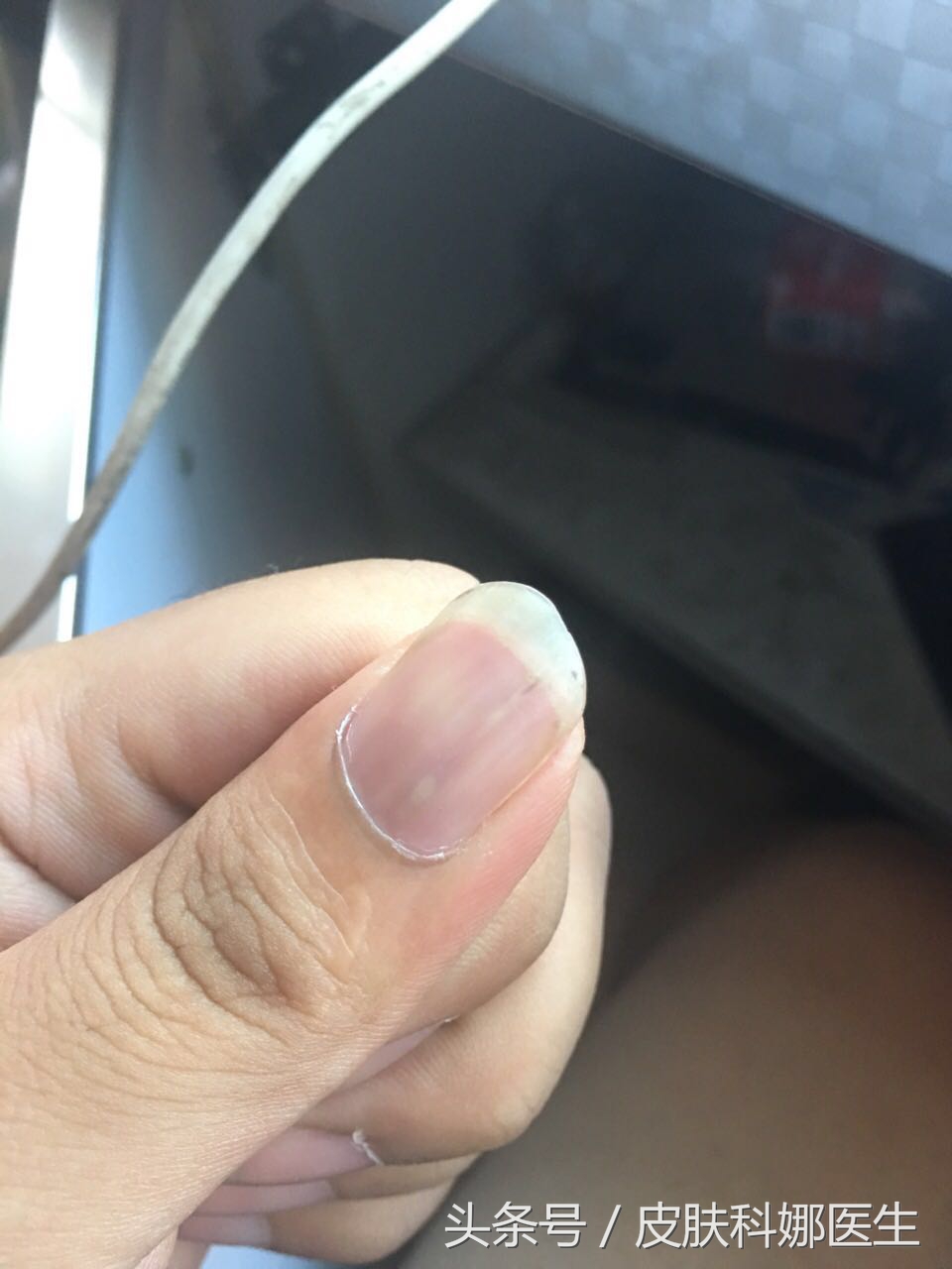 指甲上出现了一条裂缝,指甲上有竖条纹开裂是怎么回事