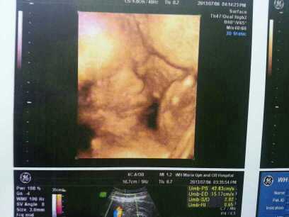 验尿查胎儿到底准不准,验尿能知道胎儿基因吗