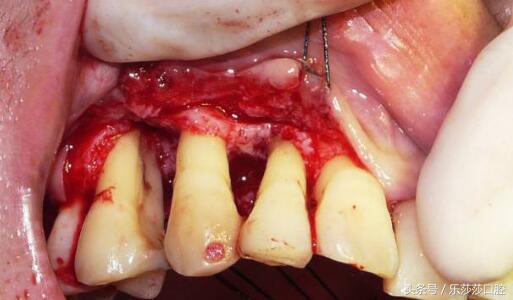 牙齿越长越往外凸怎么办,牙齿越来越长怎么回事