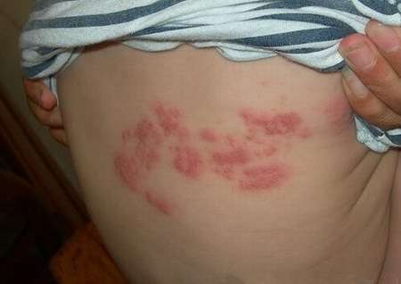 老人带状疱疹疼痛难忍的验方,带状疱疹后遗症艾灸方法