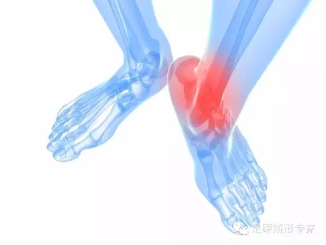 轻微扭伤脚踝没有肿胀怎么处理,足踝扭伤没骨折但肿胀需要怎么办