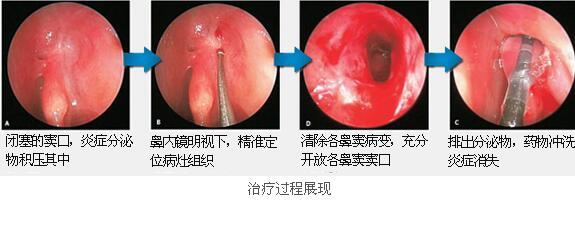 鼻炎鼻窦炎怎么治最有效的方法,鼻炎的7大分类