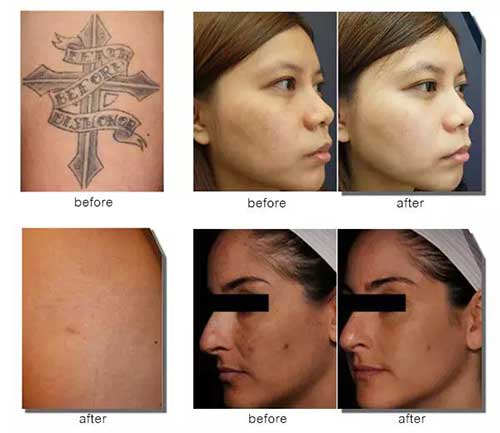 超皮秒激光祛斑2022价目表,激光皮秒祛斑一到七天变化图