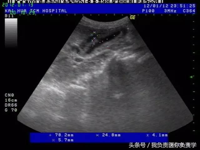 楂樻墜杩涢樁鑵拌吂璁粌,鑳嗗泭缁撶煶绌垮瓟鐥囩姸