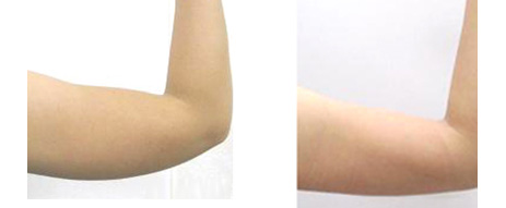 健身胳膊出汗瘦胳膊吗,胳膊转动可以瘦胳膊吗