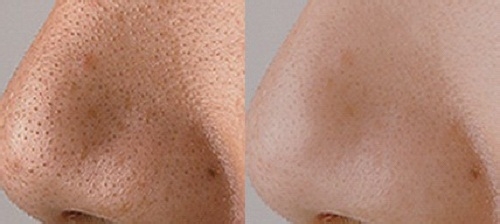 脸上的黑头的克星是什么,去黑头一招搞定快试试