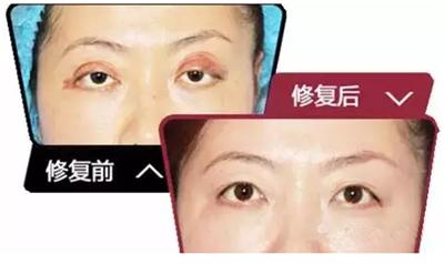 埋线双眼皮失败怎样恢复,埋线双眼皮做失败后怎么修复