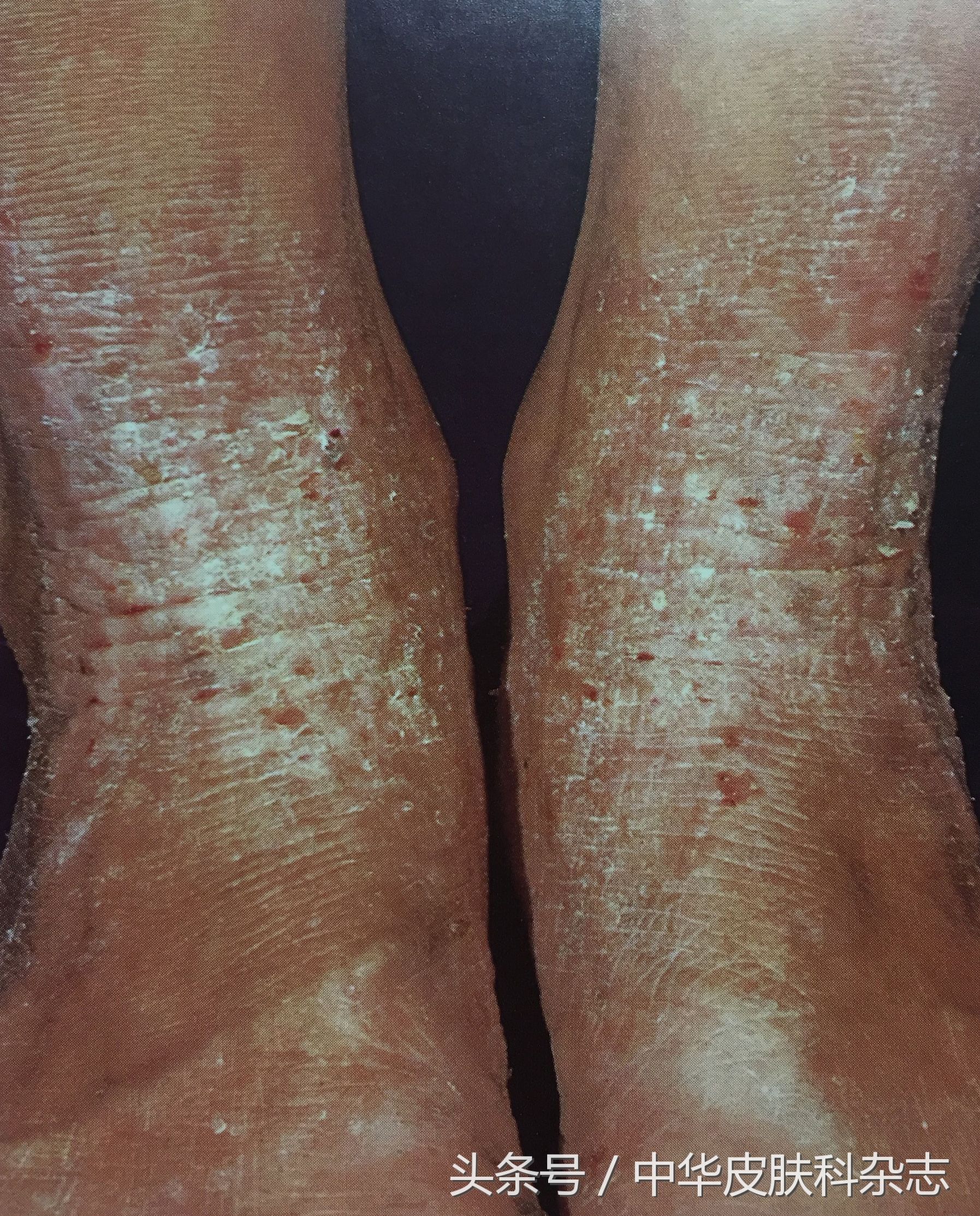 中西医结合治疗湿疹,特应性皮炎的湿疹中医治疗好吗