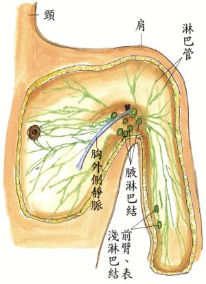 腋窝下有淋巴结会引起乳腺癌吗,腋下淋巴结会是乳腺癌吗