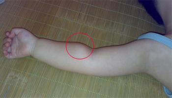 脂肪瘤怎么办教你一招解决,脂肪瘤要注意些什么自己会消失