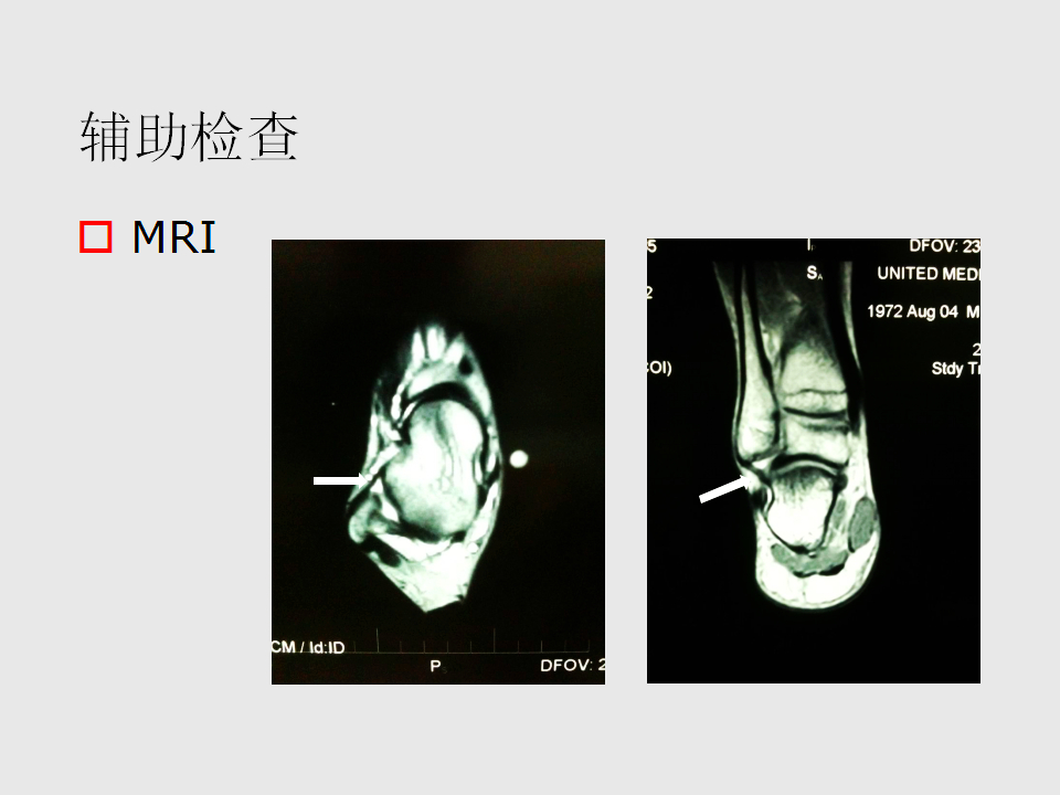 脚崴了怎么办判断是否骨折,脚崴了怎么办视频