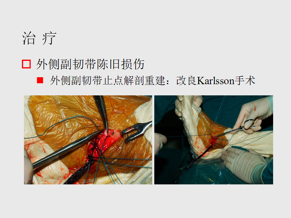 脚崴了怎么办判断是否骨折,脚崴了怎么办视频