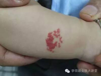 超导治疗婴幼儿血管瘤,婴幼儿面部淋巴血管瘤