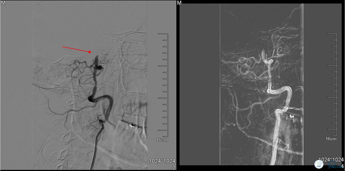 中医治疗基底动脉闭塞,基底动脉尖综合征病例分享
