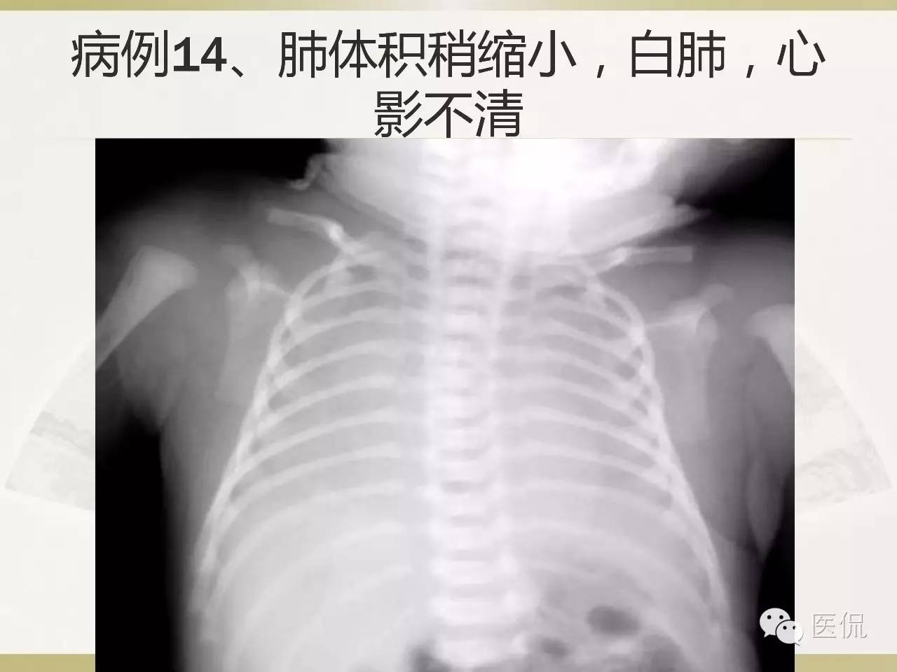 「资料丨医看分享」南边老师肺部群：新生儿透明膜病（HMD）医学影像