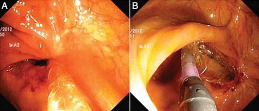 克罗恩病内镜严重程度指数,克罗恩病内镜检查是怎么样的