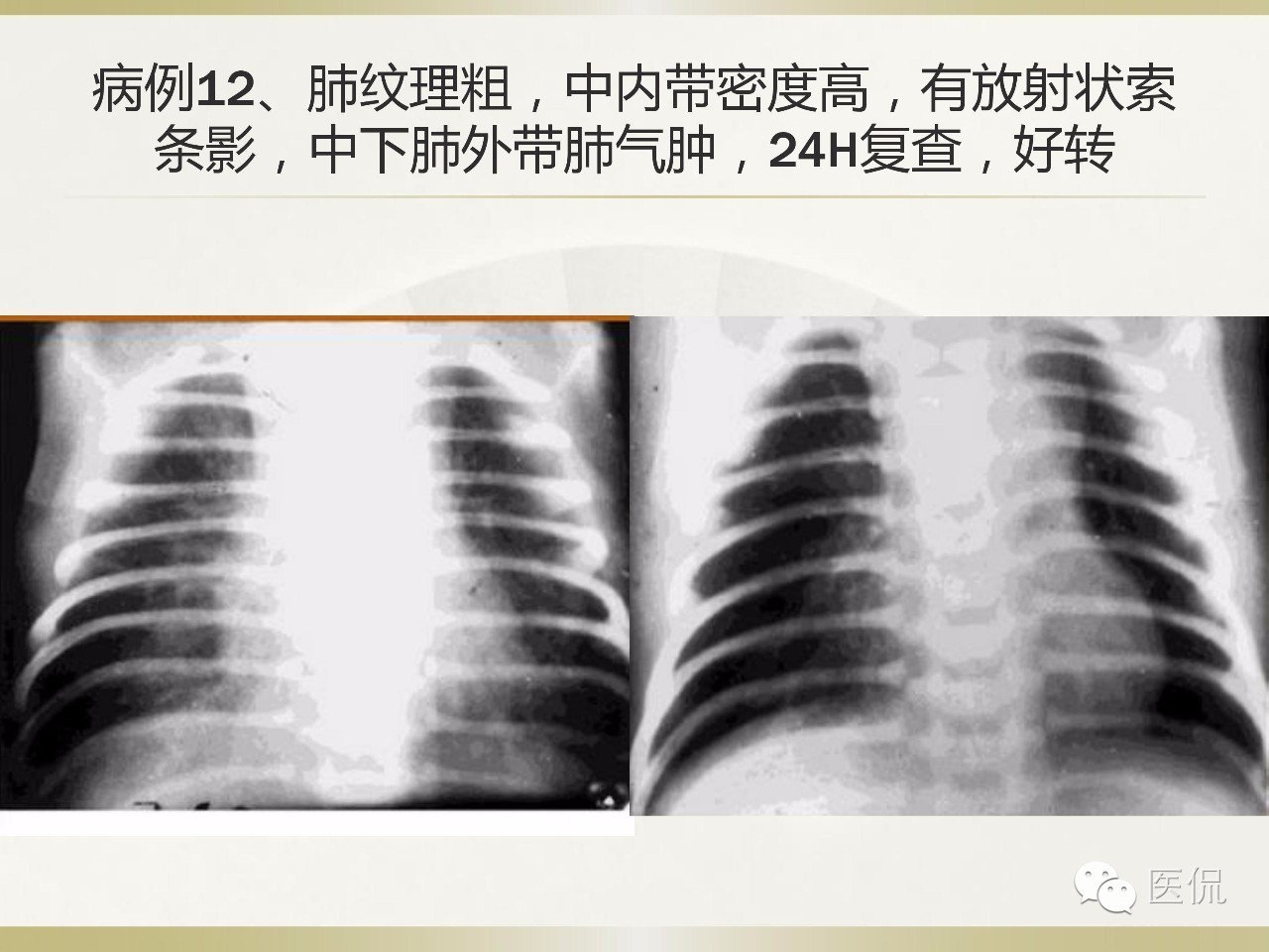 「资料丨医看分享」南边老师肺部群：新生儿透明膜病（HMD）医学影像