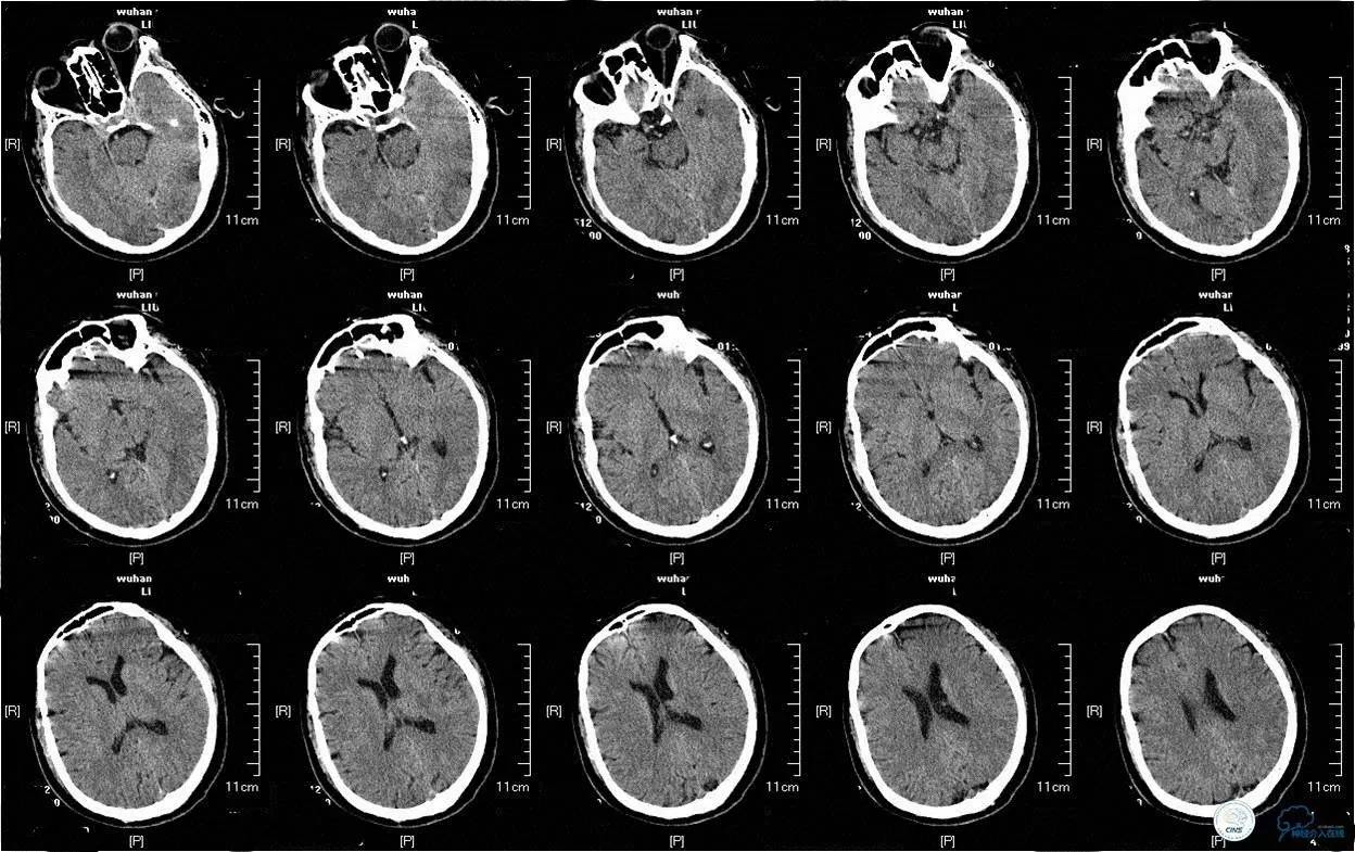 中医治疗基底动脉闭塞,基底动脉尖综合征病例分享