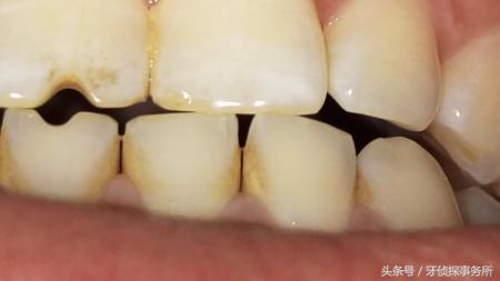 一吸凉风牙齿就酸怎么解决,一口冷风牙都会痛是怎么回事