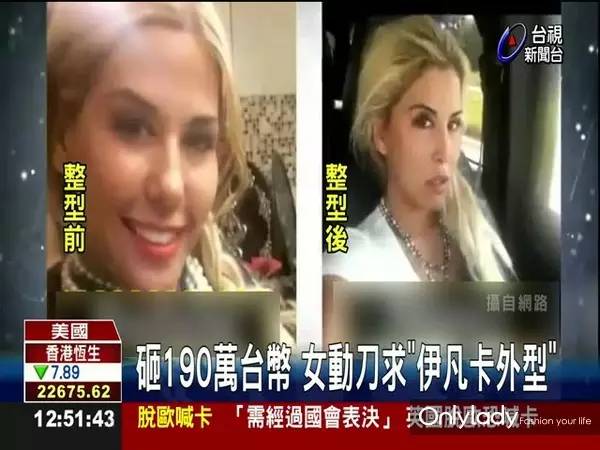 女子花4万块整容把嘴都整歪了,美国女子花76万整容