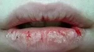 冬天嘴唇干裂破皮?这些护唇方法你一定用得上!