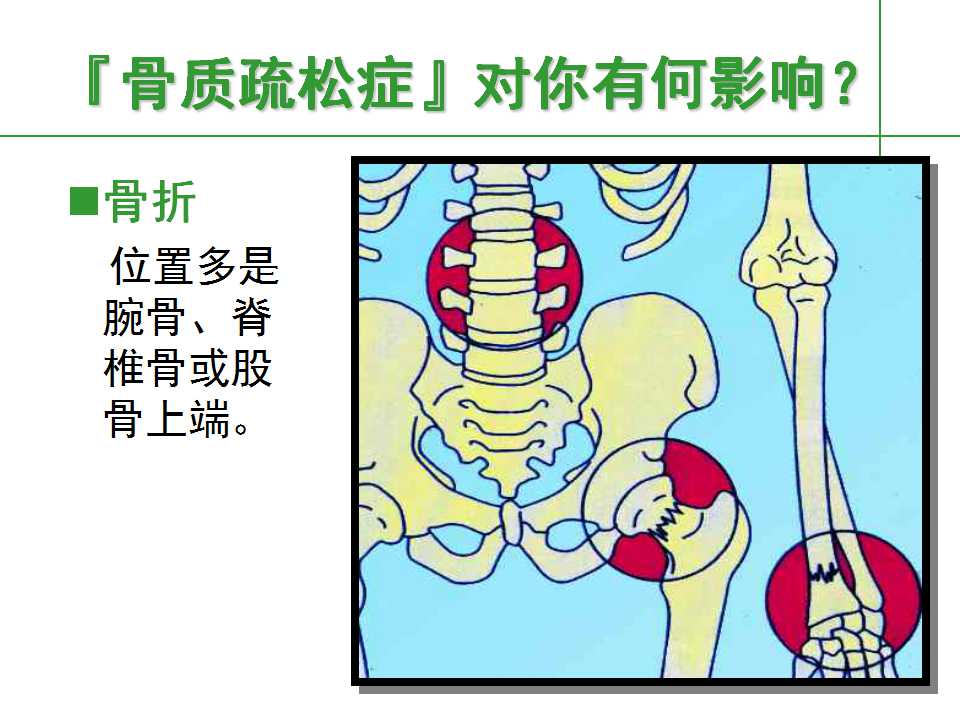 人到中年后骨质疏松要怎么治,中老年人骨质疏松该怎么办