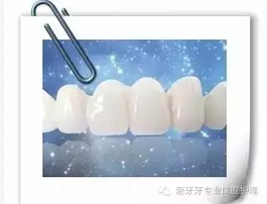 不同材质的牙冠的价格,不同价位的烤瓷牙冠