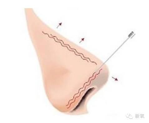 林允是不是整鼻子了,林允隆鼻过吗