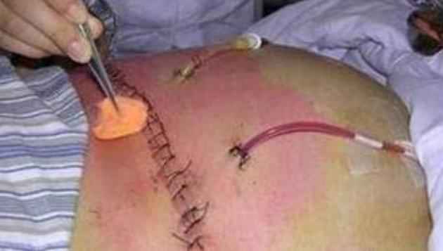 剖腹产要经过几道工序,剖腹产只需切一层