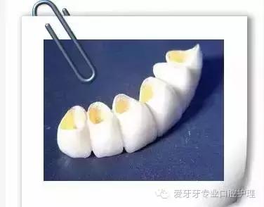 不同材质的牙冠的价格,不同价位的烤瓷牙冠