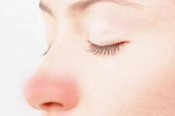 玫瑰痤疮酒渣鼻刚开始什么样子,酒渣鼻属于痤疮吗