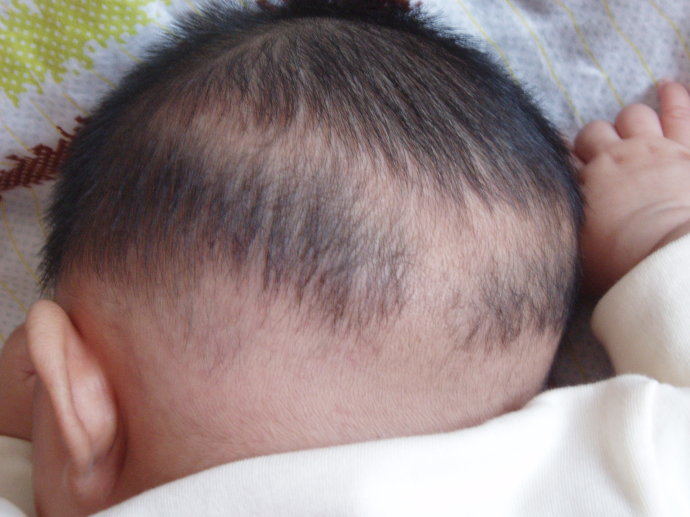 宝宝脱发去医院看什么科,宝宝脱发怎么治