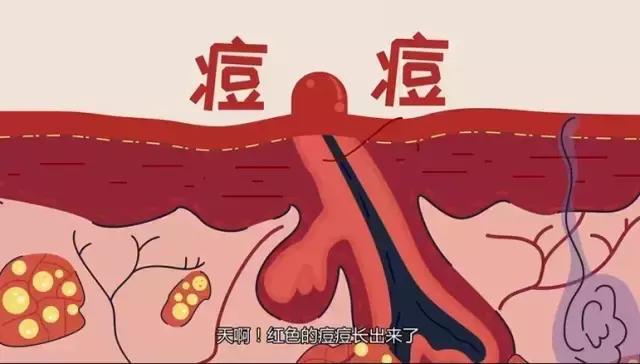 痘痘黑头粉刺怎么治最有效,协和医生图说治痘痘最好的方法