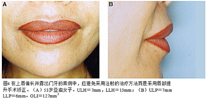 欧洲、亚洲、非洲丰唇标准及注射剂量