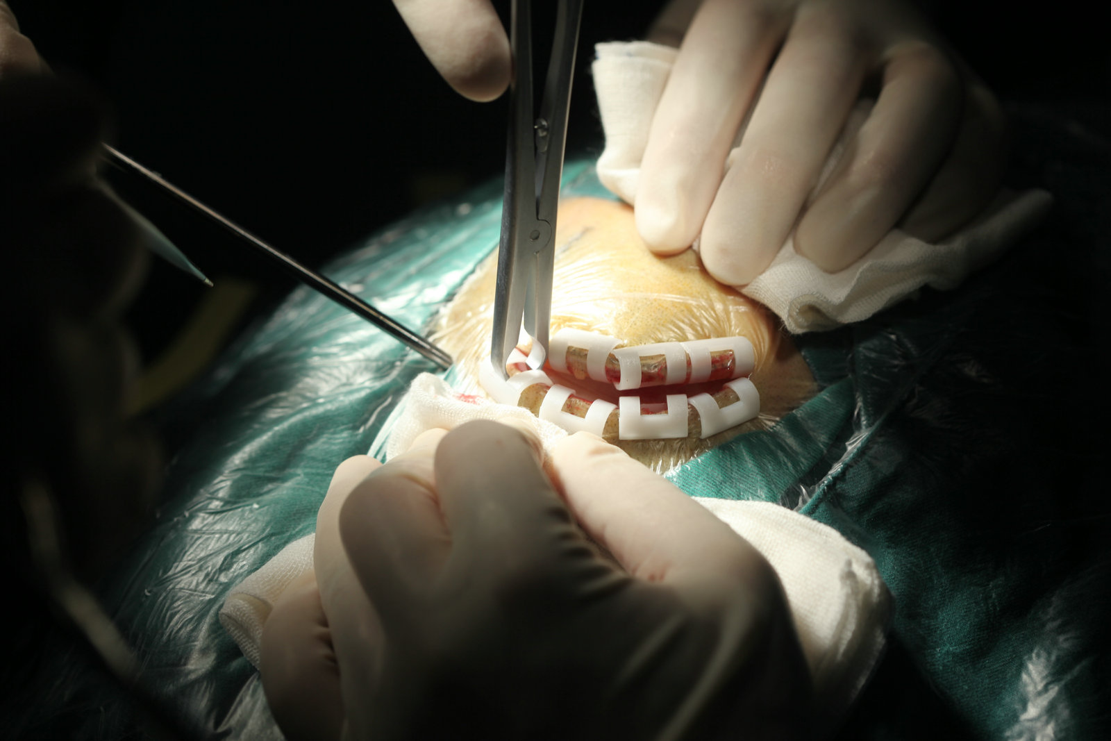 神经外科纪实视频,显微神经外科手术费用