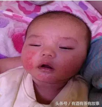 湿疹过敏超级痒,宝宝过敏湿疹妈妈怎么忌口